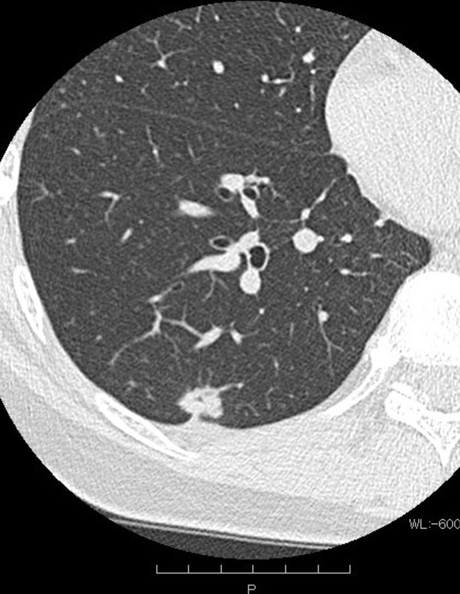 結節影・腫瘤影イメージ画像