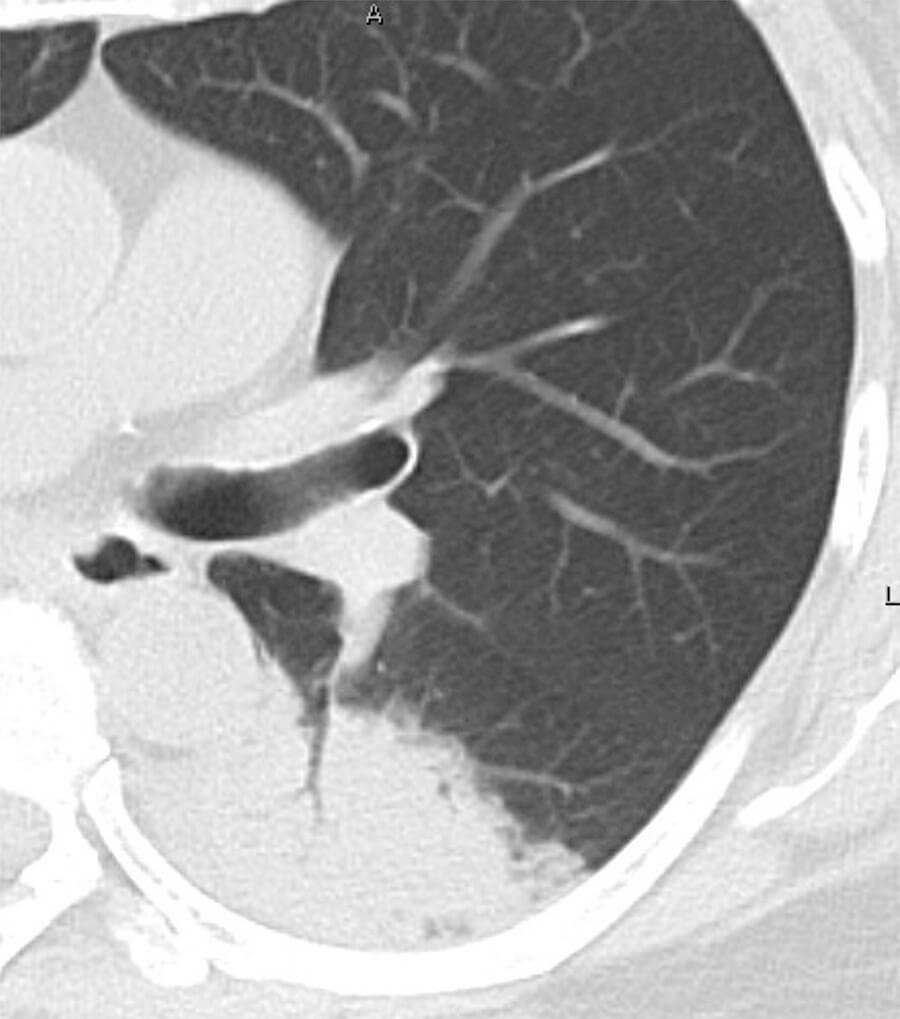 浸潤影イメージ画像